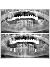 Dental Implants - DENTALİSA CLİNİC