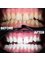 Estedian Dental - Antalya - Estedian Dental Teeth Whitening 