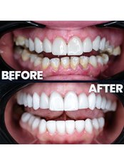 Hollywood Smile - Estedian Dental - Antalya