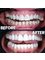 Estedian Dental - Antalya - Estedian Dental Hollywood Smile 