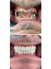 Dental Implants - İnterdentalia Smile Design