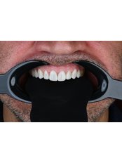 Composite Veneers - Perla Dental Centre