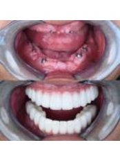 Dental Implants - Perla Dental Centre
