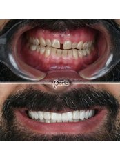 Smile Makeover - Perla Dental Centre