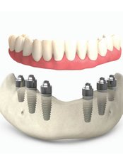 All-on-6 Dental Implants - Perla Dental Centre