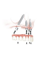 All-on-4 Dental Implants - Perla Dental Centre