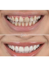 Lumineers™ - Perla Dental Centre