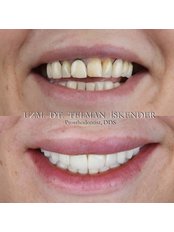 Hollywood Smile - Perla Dental Centre