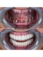 Dental Implants - Perla Dental Centre