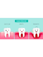 Gingivitis Treatment - Perla Dental Centre