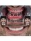 Perla Dental Centre - Full Mouth Implants + Zirconium Crowns 