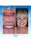 Smile Center Turkey - dental veneers antalya 