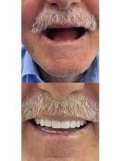 Dental Implants - Zirve Dental