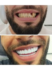 Hollywood Smile - Zirve Dental