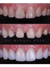 Hollywood Smile - Adaport Dental Clinic