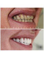 Zirconia Crown - Adaport Dental Clinic