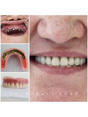 All-on-4 Dental Implants - Adaport Dental Clinic