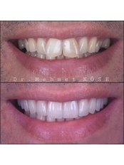 Hollywood Smile - Adaport Dental Clinic
