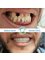 Bulent Kenir Dental Clinic - CROSSBITE FIX WITH CROWNS 