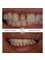 Bulent Kenir Dental Clinic - SINGLE TOOTH REPLACEMENT 