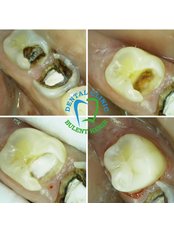 Fillings - Bulent Kenir Dental Clinic