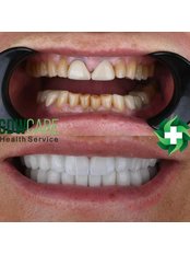 Hollywood Smile - GDWCare Health Service