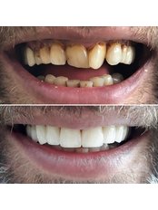 Zirconia Crown - My Nova Dental Clinic