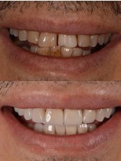 Veneers - My Nova Dental Clinic