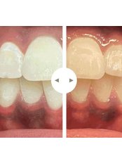 Teeth Whitening - Ozbak Dis