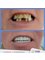Park Dental - Before & After Zirconium Crowns 