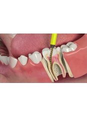 Root Canals - Park Dental