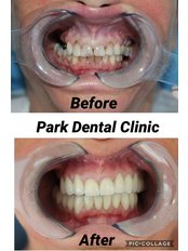 Zirconia veneers - Park Dental