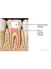 Root Canals - Park Dental