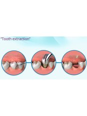 Extractions - Park Dental