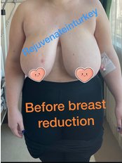 Breast Reduction - Rejuvenate In Turkey