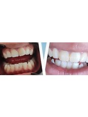 Dental Bonding - Seali̇ght Dent