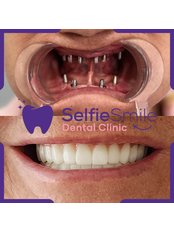 Dental Implants (30 mins, 2 sessions) - Selfi̇e Smi̇le Dental Cli̇ni̇c