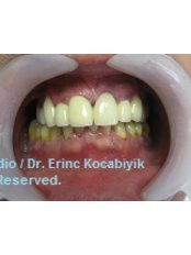 Dentures - Smile In Turkey