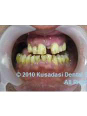 Dentures - Smile In Turkey