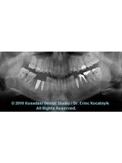 Dental Implants - Smile In Turkey