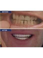 Hollywood Smile - The Smile Expert Clinic