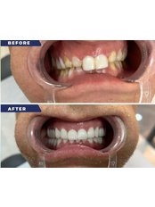 Zirconia Crown - The Smile Expert Clinic