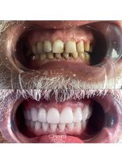 Zirconia Crown/Veneer (Monolithic) - White Dental Turkey