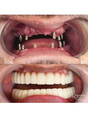 Dental Implants - White Dental Turkey
