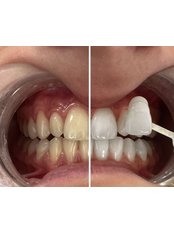 Teeth Whitening - ARMERDENT