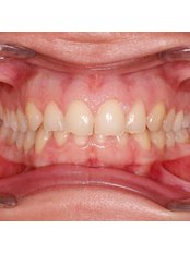 Teeth Whitening - Minimal Agiz Ve Dis Sagligi Poliklinigi