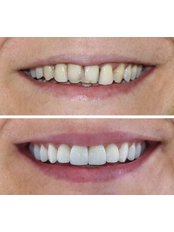 Dental Crowns - Neta Dental Clinic