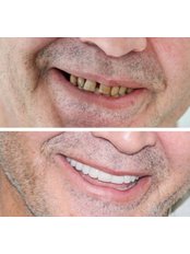 Dental Implants - Neta Dental Clinic