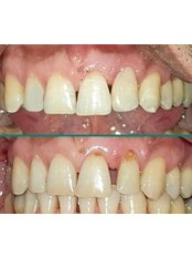 Dental Filling - Neta Dental Clinic