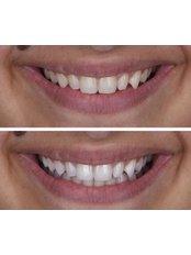 Teeth Whitening - Neta Dental Clinic